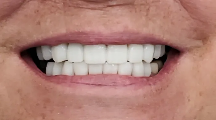 Before and after dental result