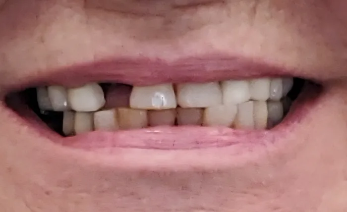 Before and after dental result
