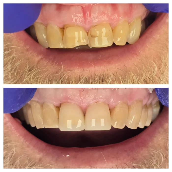Before and after dental result