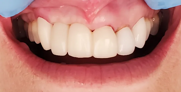 Before and after dental result