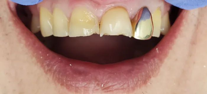 Before and after dental result
