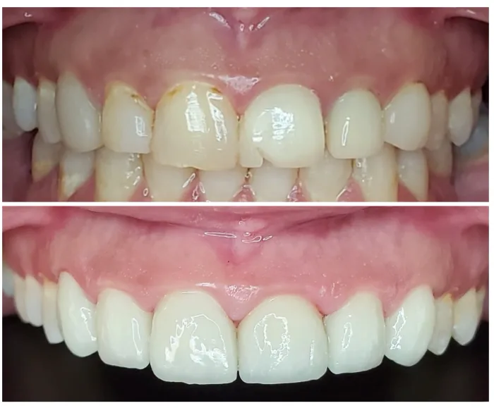 Before and after dental result