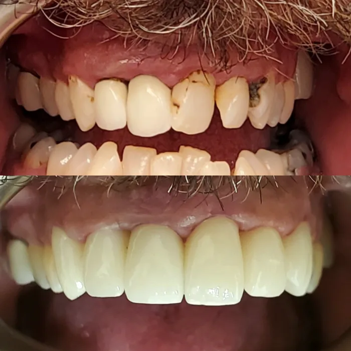 Before and after dental result