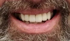 Before and after dental result