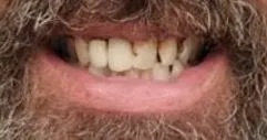 Before and after dental result