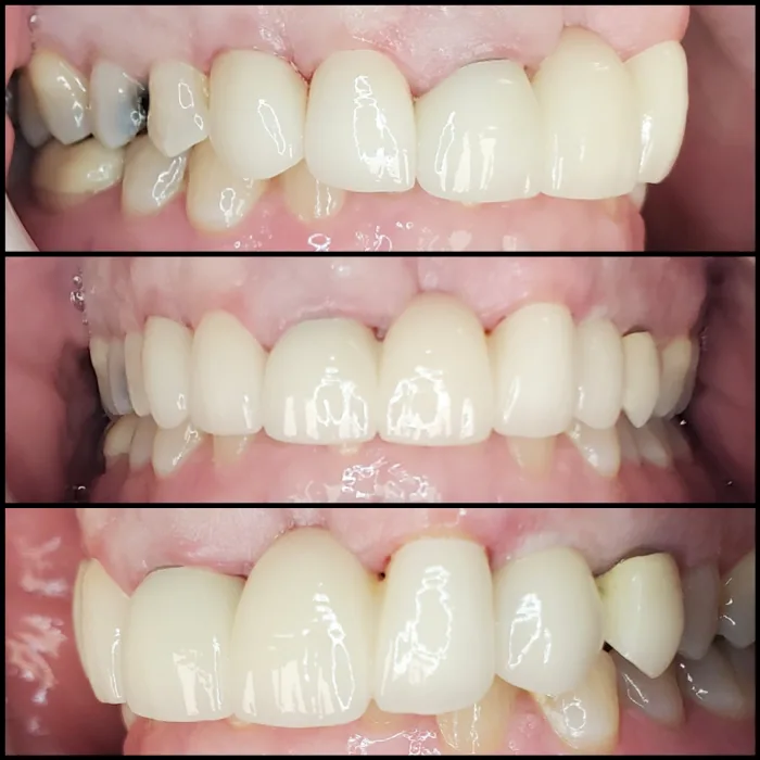 Before and after dental result