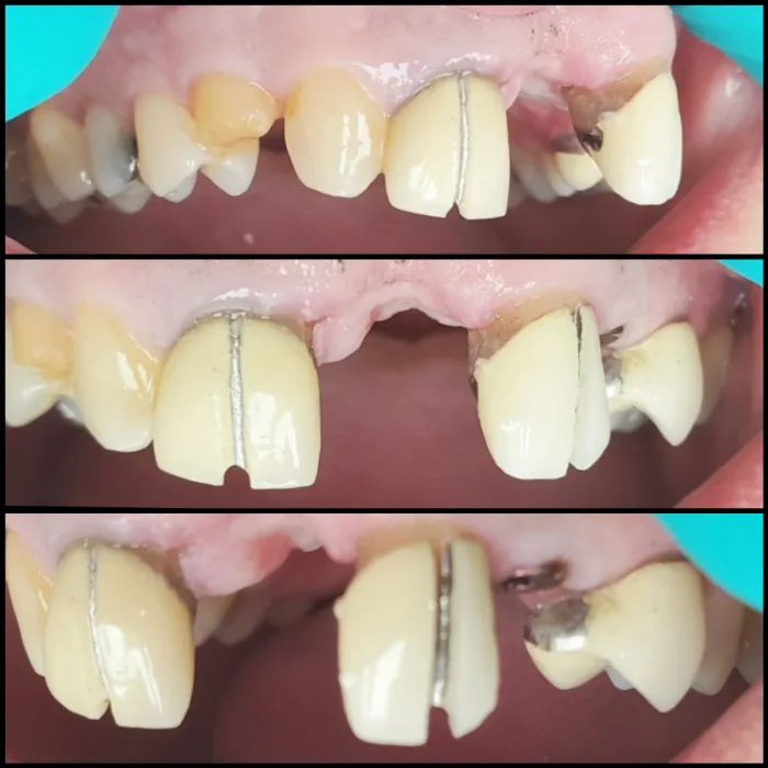 Before and after dental result