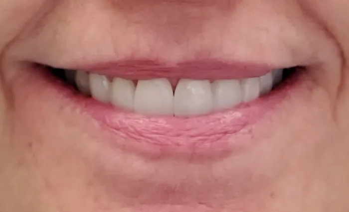Before and after dental result