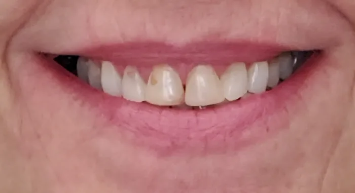 Before and after dental result