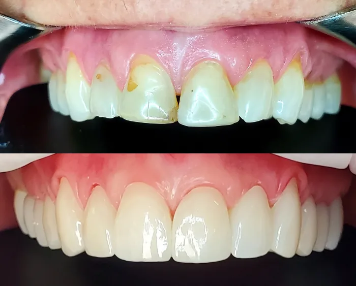 Cosmetic dentistry before and after result in Killeen