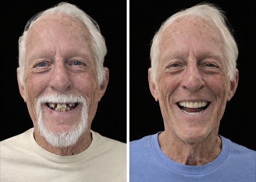 Before-and-after full-arch dental implant result at Elm Ridge