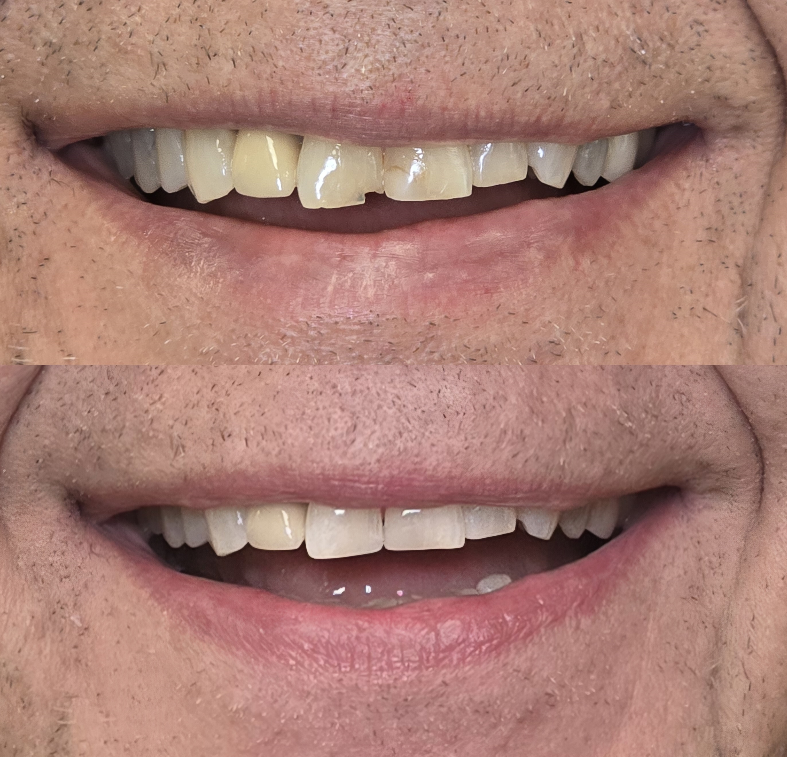 Composite bonding close-up result