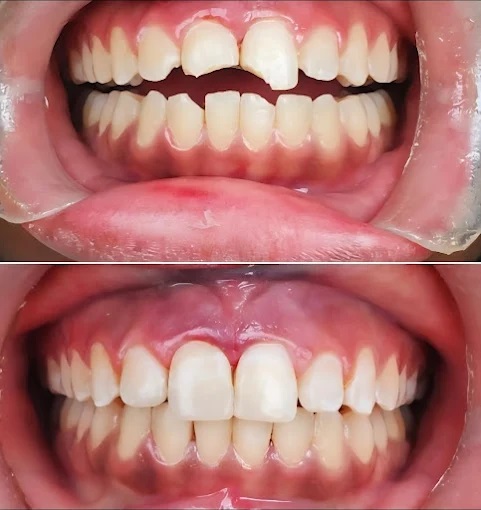 Composite bonding dental result at Elm Ridge in Killeen