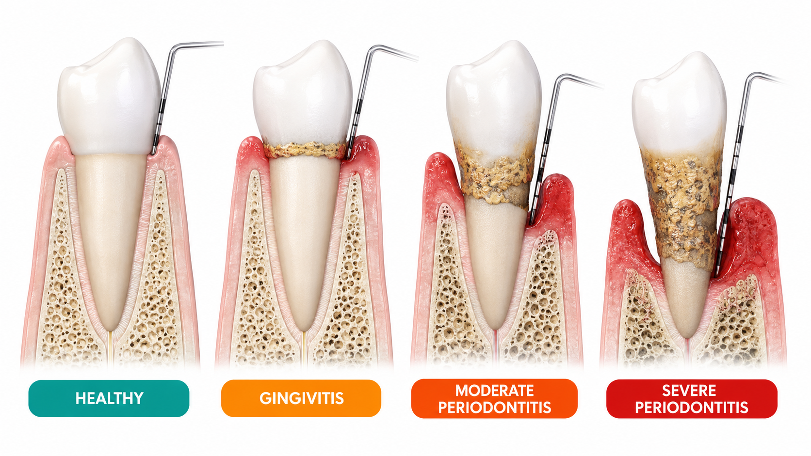Deep cleaning and gum health treatment for periodontitis in Killeen