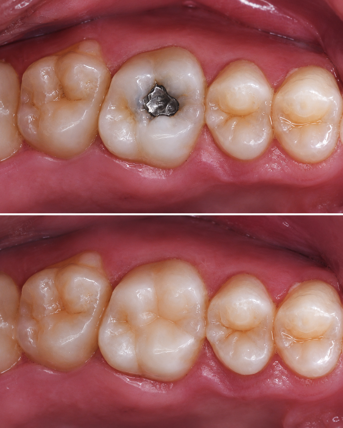Tooth-colored dental filling replacing an old metal filling