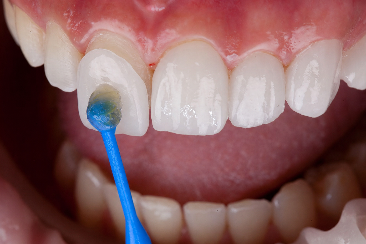 Porcelain veneer being placed on a front tooth