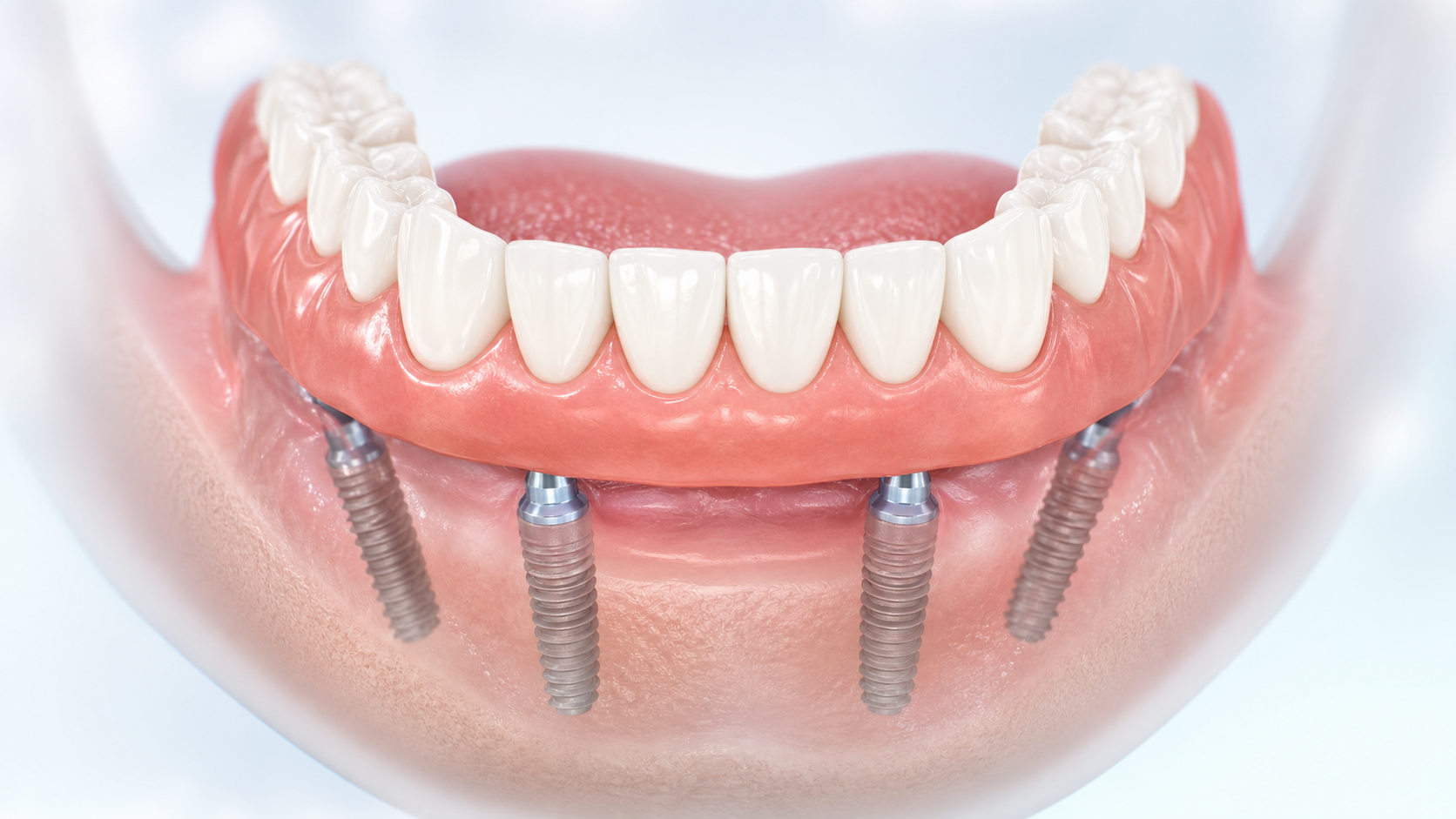 Full-arch dental implants supporting fixed implant teeth