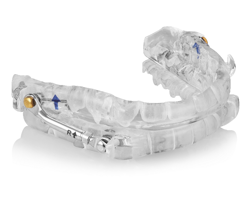 Custom mandibular advancement oral appliance for sleep apnea