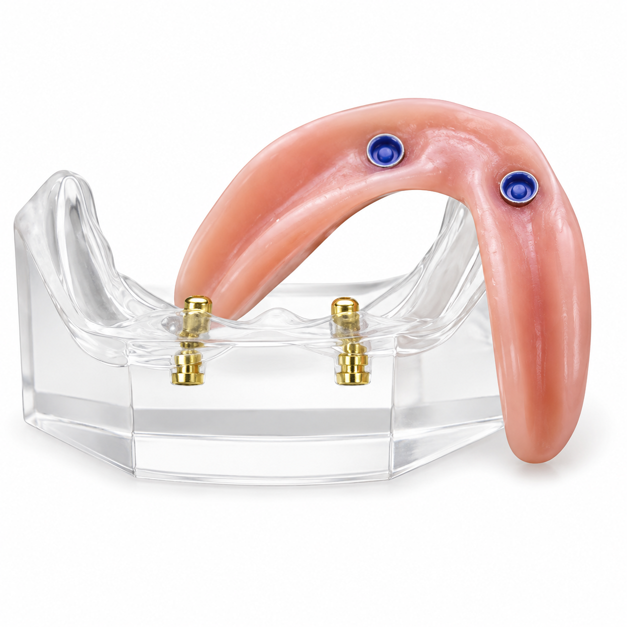 Snap-on implant denture designed for improved denture stability