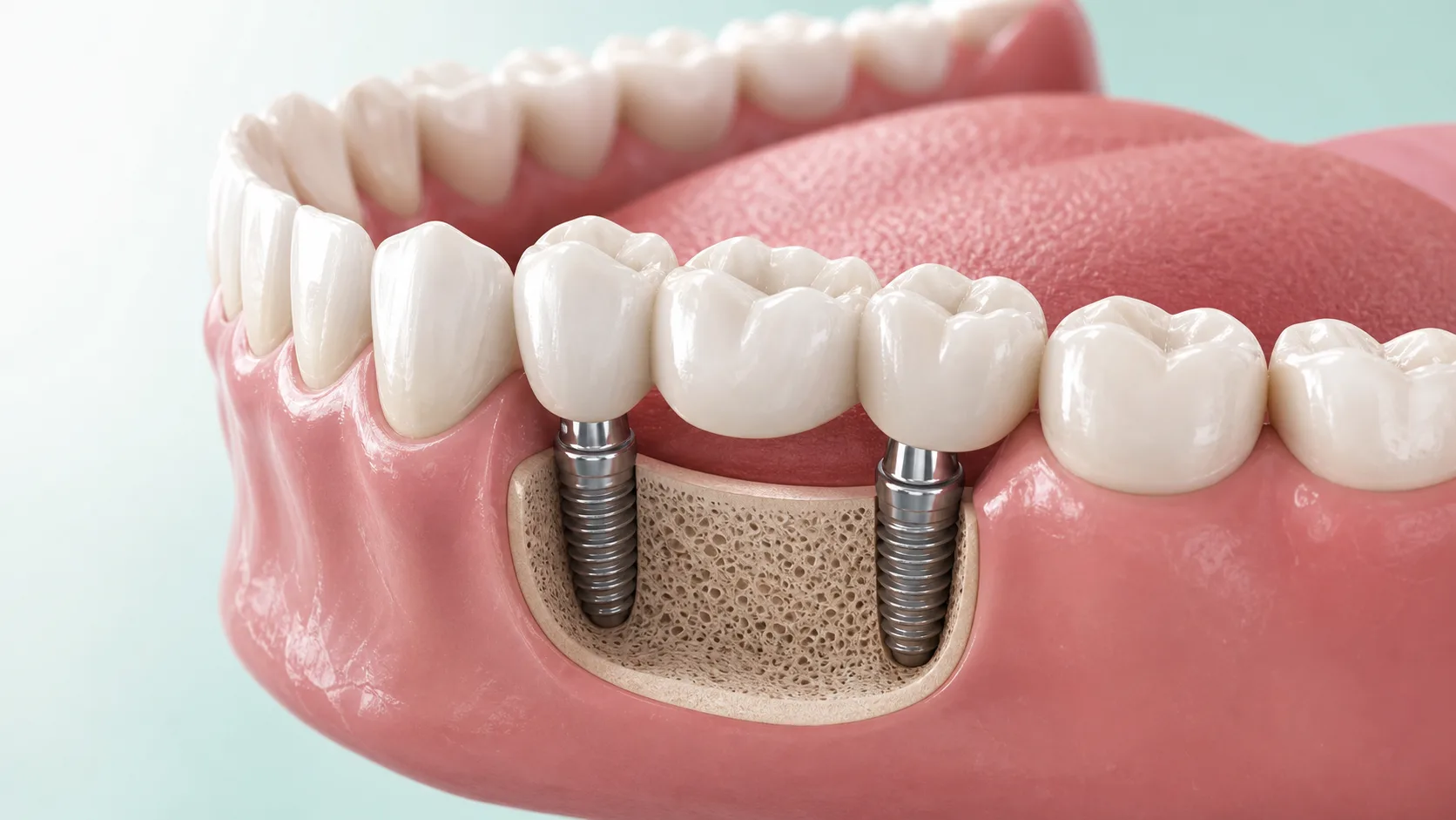 Dental implant bridge illustration at Elm Ridge Implant and Family Dentistry in Killeen, TX