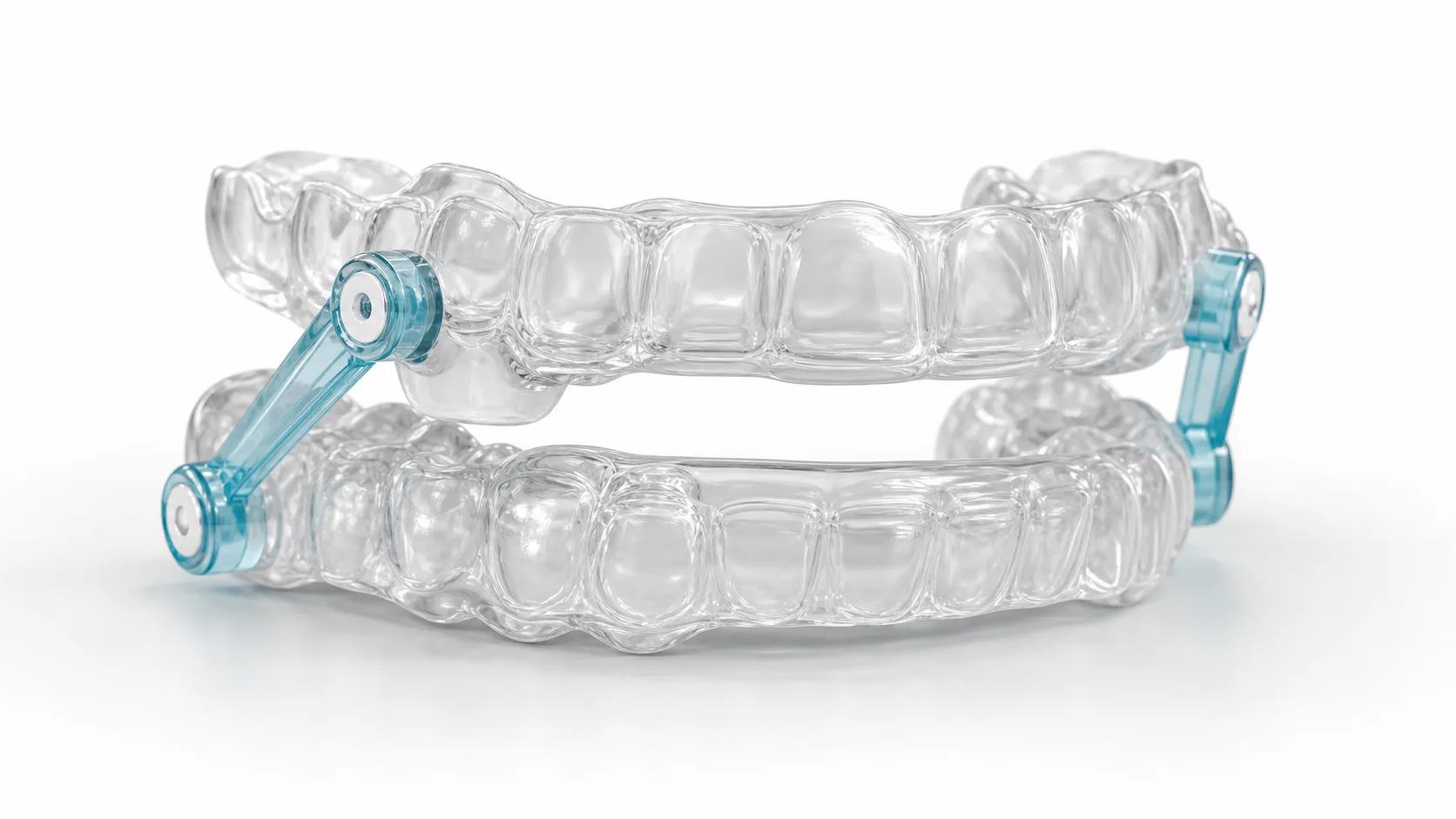 Custom mandibular advancement oral appliance for sleep apnea treatment