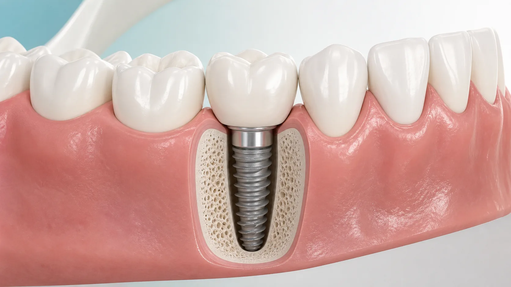 Single tooth dental implant illustration at Elm Ridge Implant and Family Dentistry in Killeen, TX